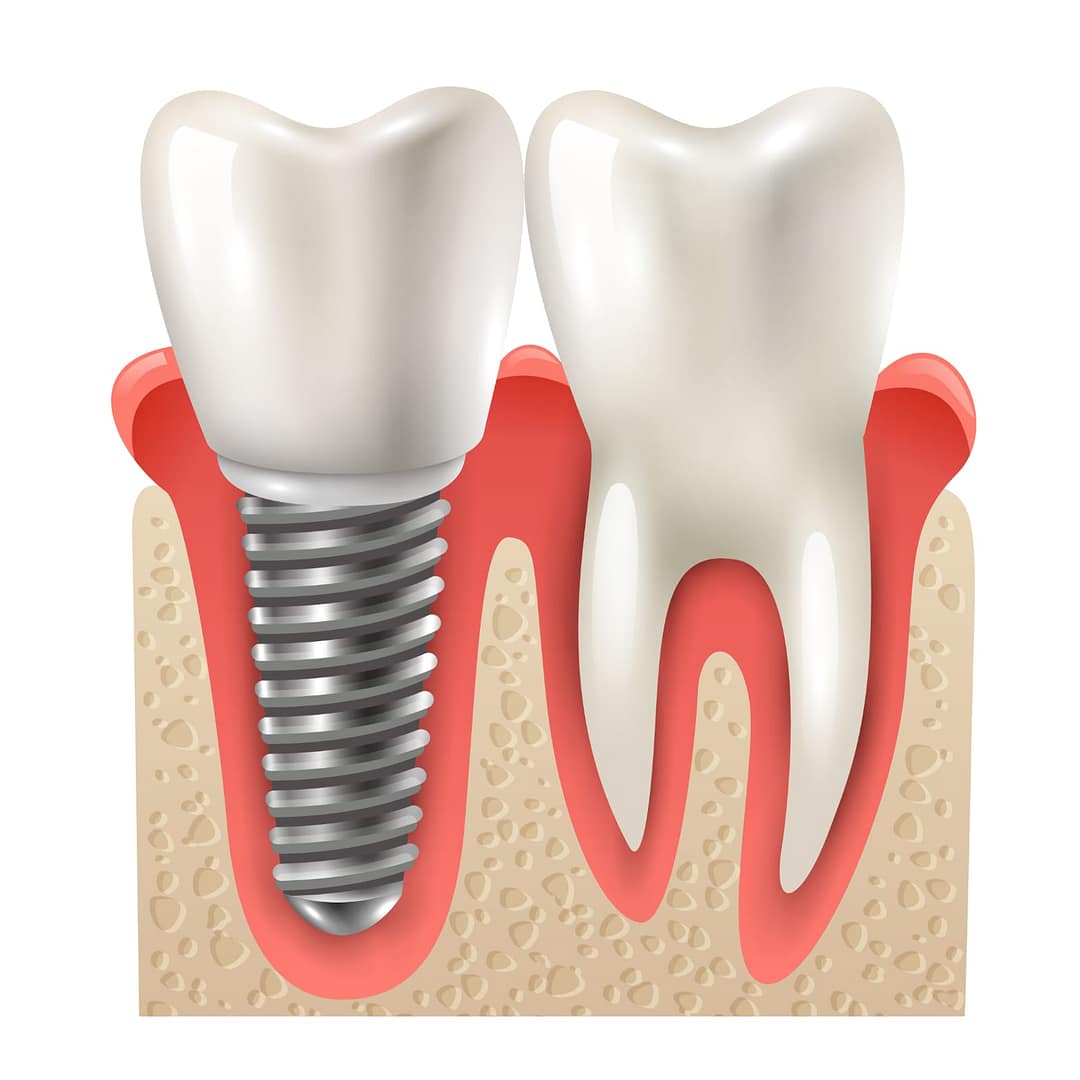implante dental em fortaleza